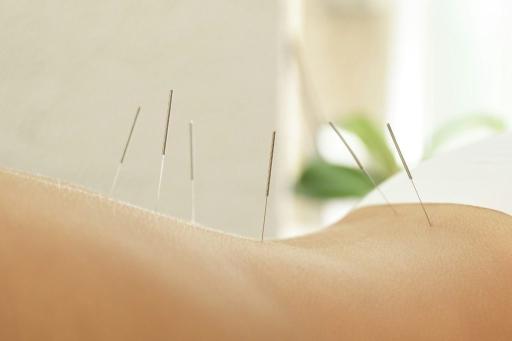 Female back with steel needles during procedure of acupuncture therapy